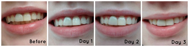 diamond white teeth whitening reviews