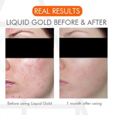 alpha h liquid gold reviews for acne
