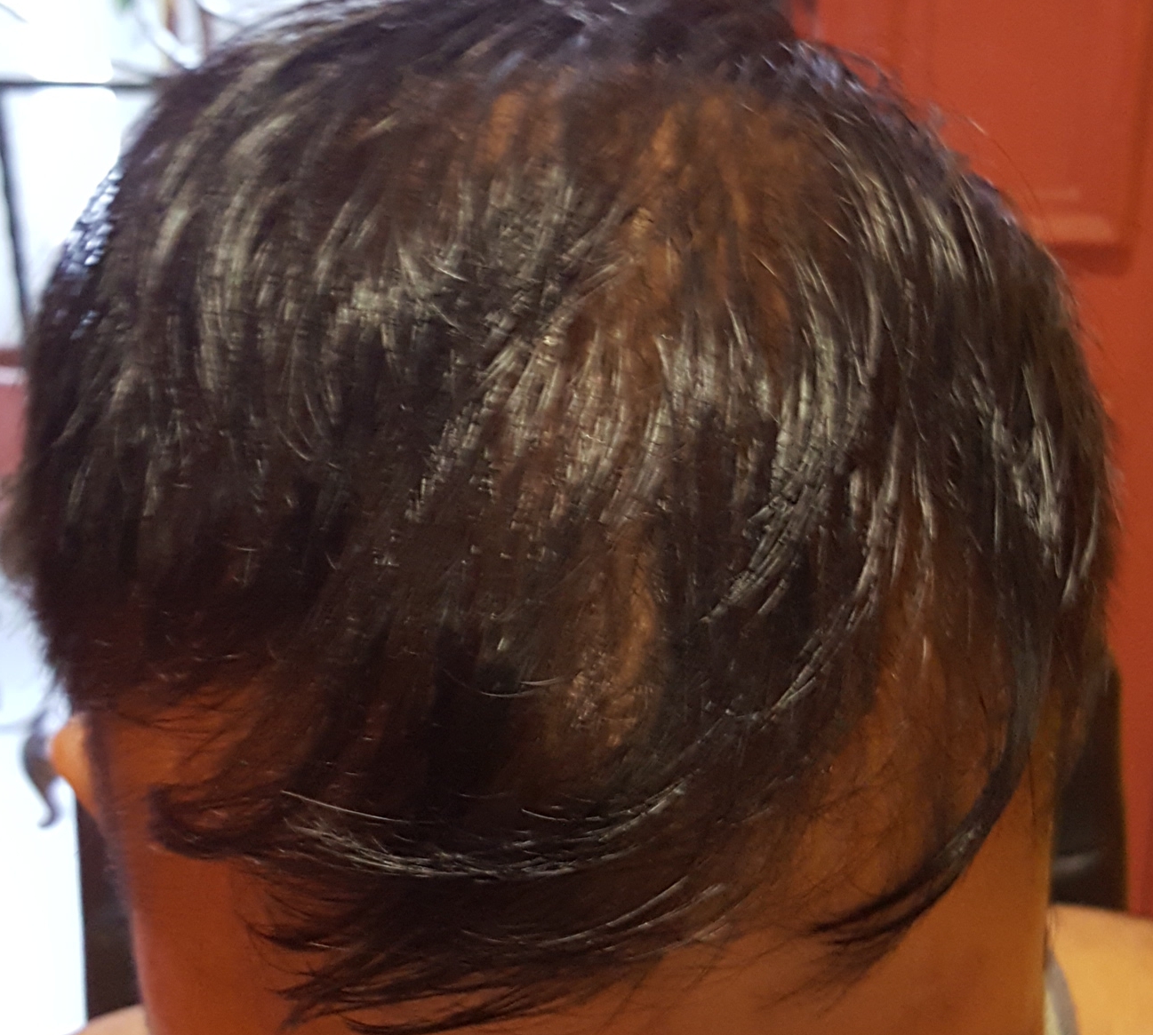 best hair loss treatment singapore review
