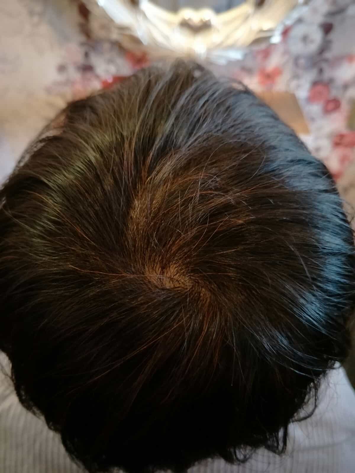 best hair loss treatment singapore review